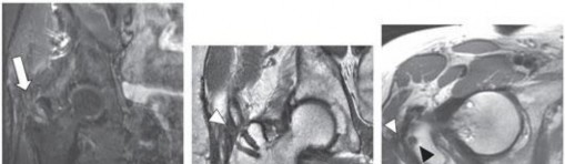 Illustration 60 for Periarticular Arthroscopy: Addressing Medius & Minimus Tears