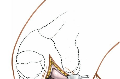 Illustration 56 for Mastering Knee Approaches: Spotlight on Superficial Medial Ligament