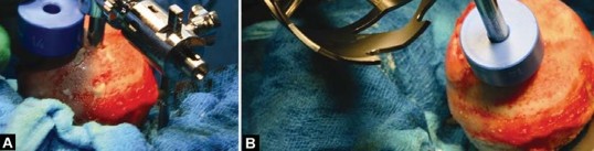 Illustration 83 for Birmingham Hip Resurfacing Designer's Technique for Active Lives