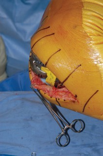 Illustration 49 for Mastering Gap Balancing in Revision TKA: Avoid Common Pitfalls