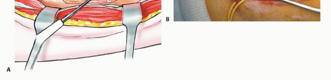 Illustration 18 for Beyond Amputation: The Type I Resection in Fibular Tumor Surgery
