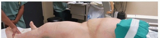 Illustration 11 for Mastering Fixation of Periprosthetic Fractures of the Femur