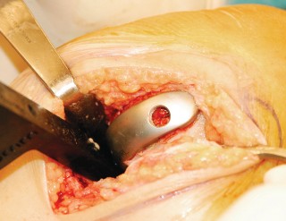 صورة طبية: تقويم مفصل الركبة أحادي الحجرة دليل شامل للمرضى في صنعاء