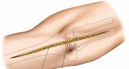 Illustration 48 for Mastering the Approach to the Distal Humerus: Safety & Skills