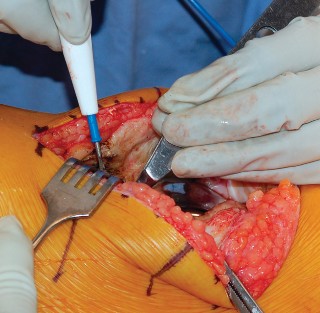 Illustration 13 for Mastering Gap Balancing in Revision TKA: Avoid Common Pitfalls