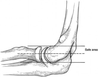 Illustration 54 for Master Diagnosis: Shoulder & Elbow Cases (Reproduced with Permission)