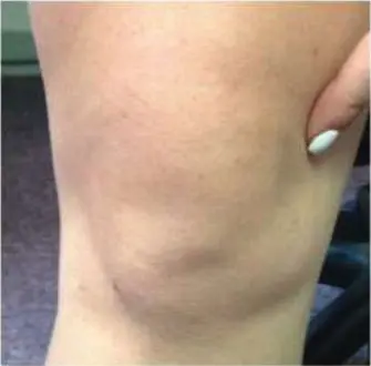 صورة توضيحية لـ ألم الركبة الأمامي عند الأطفال: دليل شامل للتشخيص والعلاج الفعال مع الأستاذ الدكتور محمد هطيف