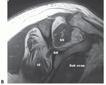 Illustration 5 for Restore Shoulder Function with Latissimus Dorsi Tendon Transfer