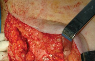 Illustration 6 for Femoral Stem Revision: Posterior Approach for Better Outcomes