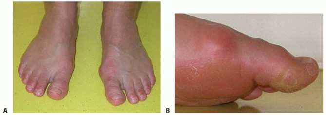 Illustration 4 for Optimizing Internal Fixation of Sesamoid Fractures