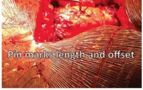 Illustration 7 for Extensively Porouscoated Stems: Proven Success & Superior Fixation