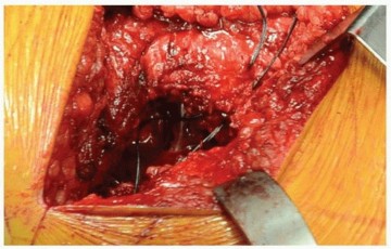 صورة توضيحية لـ استبدال مفصل الورك الكلي: النهج الخلفي الجانبي الموسع والتدخلي المحدود