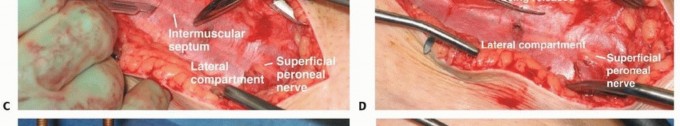 Illustration 12 for Acute Compartment Syndrome: Timely Fasciotomy Explained