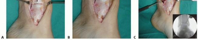 Illustration 12 for Painful Talus Lesions? The tech fig c Osteochondral Transfer Solution