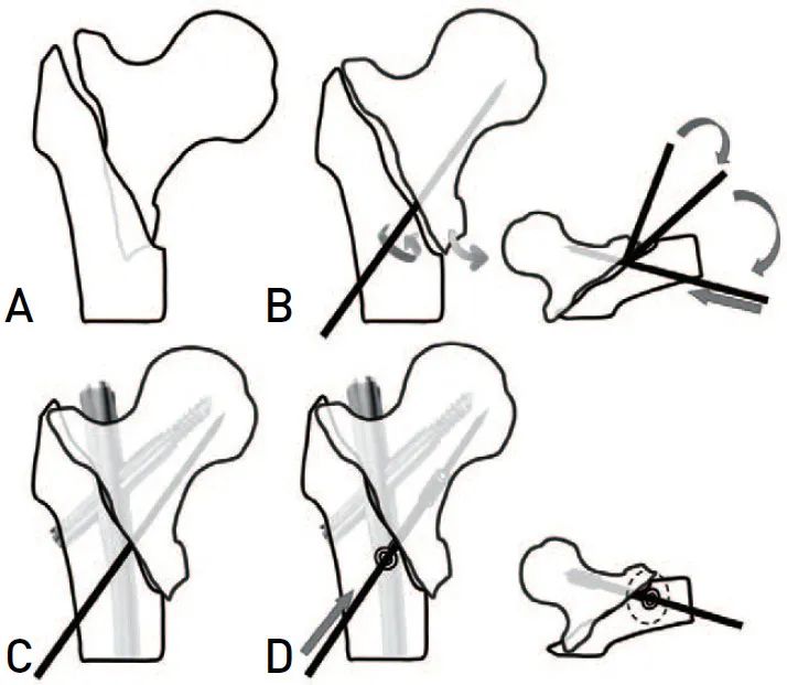 转子间骨折头髓钉复位高失败率？创新辅助螺钉技术，精准复位防失效，全面杜绝螺钉滑动隐患！