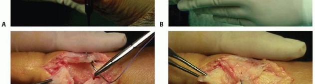 Illustration 26 for Mastering the Biplanar Distal Chevron for Effective Bunion Surgery
