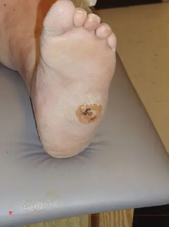 صورة توضيحية لـ اعتلال شاركو العصبي: دليل شامل لتشخيص وعلاج القدم الوتدية جراحيًا