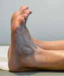 Illustration 17 for Partial Articular Fractureplate Fixation: Restore Anatomy