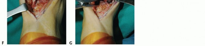 Illustration 15 for Optimize Pain Management with Proximal Ring Block for Ankle Arthrodesis