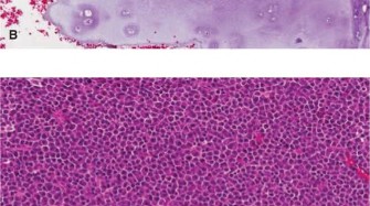 Illustration 5 for Diagnostic Dilemma: Unpacking Oncology Cases Enchondroma