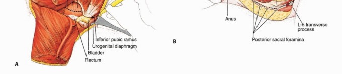 Illustration 37 for Anterior Flap Hemipelvectomy: Leveraging fig tech fig for Difficult Tumors