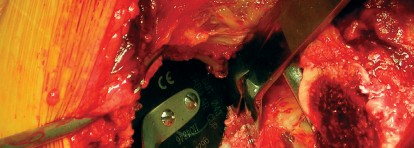 Illustration 31 for Cemented Component Longevity: The Critical Margin of the Acetabulum