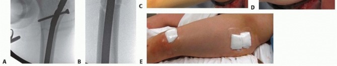 Illustration 26 for Pediatric Femoral Nailing: Targeting the Right aspect of the greater Trochanter