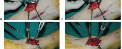 Illustration 31 for Mastering Midfoot Arthrodesis: Protect the Deep Neurovascular Bundle