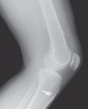 Illustration 4 for Successful Ligament Repair Revision: Fixing Failed ACLs