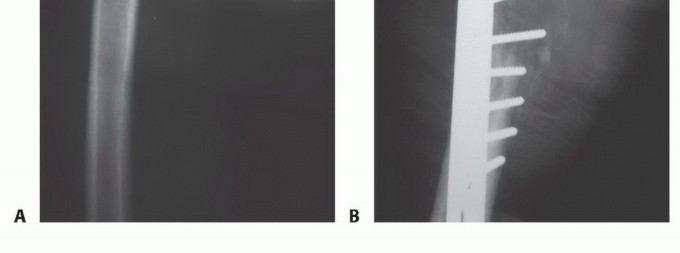 Illustration 5 for Plain Radiograph Showing MBD: Surgical Planning to Prevent Failures