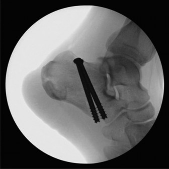 Illustration 3 for Urgent Ankle Cases: What to Do for a 33-Year-Old Fracture?