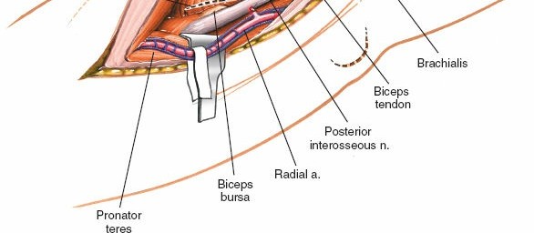 Illustration 63 for Mastering Elbow Approaches: Applied Surgical Anatomy for Precision