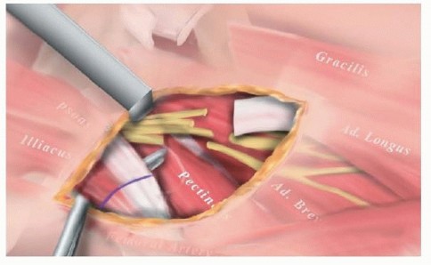 Treat Spastic Hip Disease: Hamstring & Adductor Lengthening