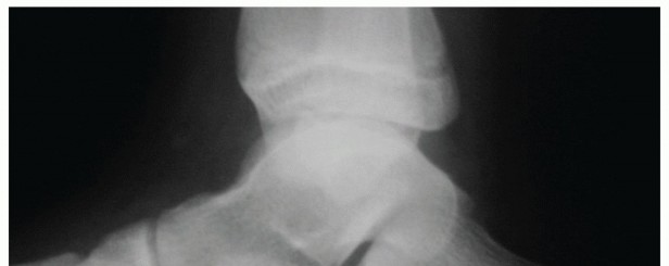 Restore Arch & Function: Medial Displacement Calcaneal Osteotomy