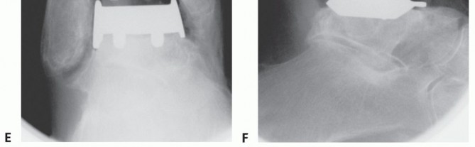 Illustration 29 for HINTEGRA Total Ankle: Unlocking Natural Ankle Movement