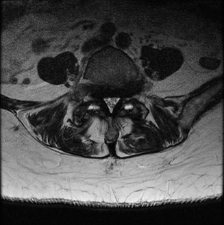 Illustration 16 for Spine Cases: Consider the Patient for Accurate Diagnosis