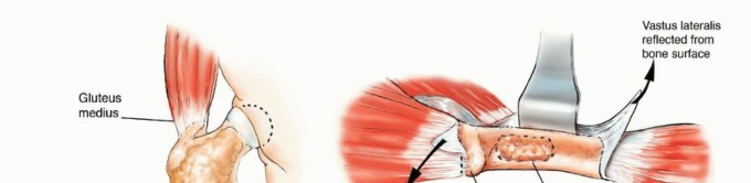 Illustration 10 for Mastering Femoral Metastases: Optimal Function for Femoris & Vastus