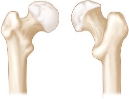 Illustration 22 for Figure Hip Resurfacing: Who Benefits and Who Should Avoid It?