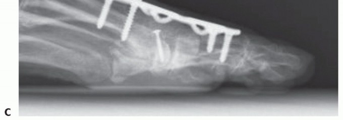 Illustration 76 for End Articular Cartilage Loss: Arthrosurface HemiCAP Resurfacing