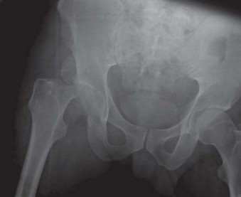 Illustration 12 for Navigating Early THA for Fractures of the Acetabulum