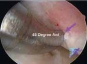 Illustration 15 for Microfracture Chondroplasty: How Tiny Holes Are Made to Fix Cartilage