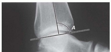 Illustration of lengthening of gastrocnemius - Dr. Mohammed Hutaif