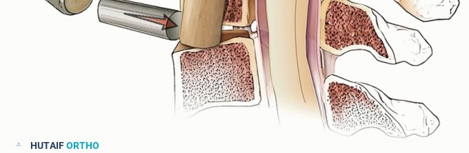 Illustration 27 for Stop Numbness & Instability: Corpectomy and Fusion Guide