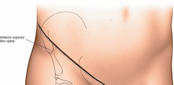 Illustration 53 for Pelvis & Acetabulum Approaches: Unlocking the Posterior Superior Iliac