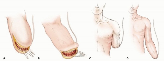 Illustration 25 for Above-Elbow & Below-Elbow Amputations: When & Why They're Needed