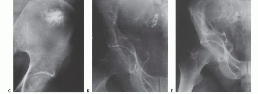 Illustration 4 for Surgical Pelvic Resection: Gluteus Maximus Muscle & Nerve Preservation