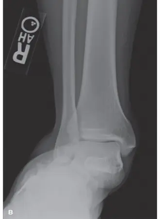 صورة توضيحية لـ انسداد رد كسر الكاحل بسبب العضلة الباسطة للأصابع القصيرة (EDB): الحل الجراحي الأمثل في صنعاء