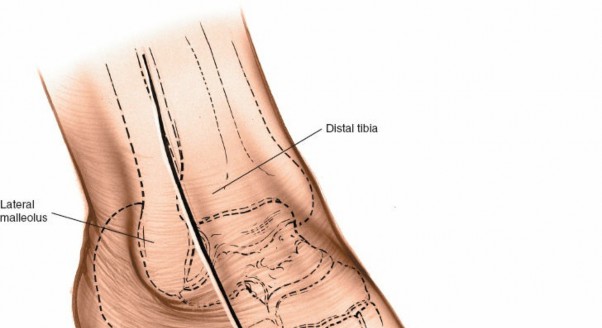 Illustration 86 for Optimized Approaches to the Dorsum of the Foot & Ankle