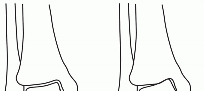 Illustration of osteotomy with internal - Dr. Mohammed Hutaif