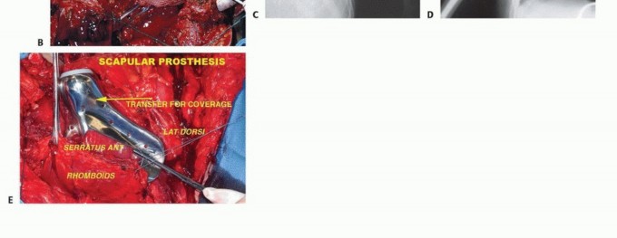 Illustration 25 for Distal Femoral Replacement: Key to Modern Limb Salvage